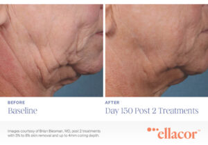 Ellacor before and after 2 treatments
