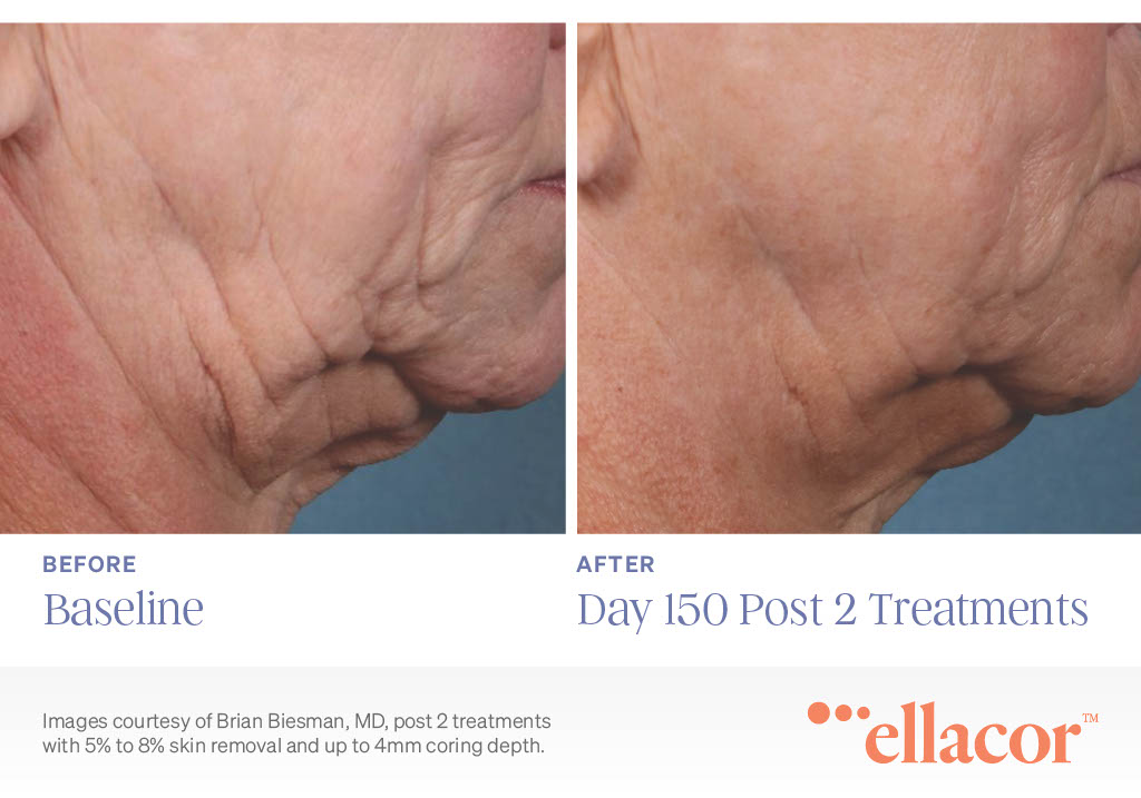 Ellacor before and after 2 treatments