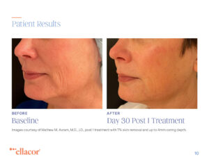 Ellacor before and after one treatment